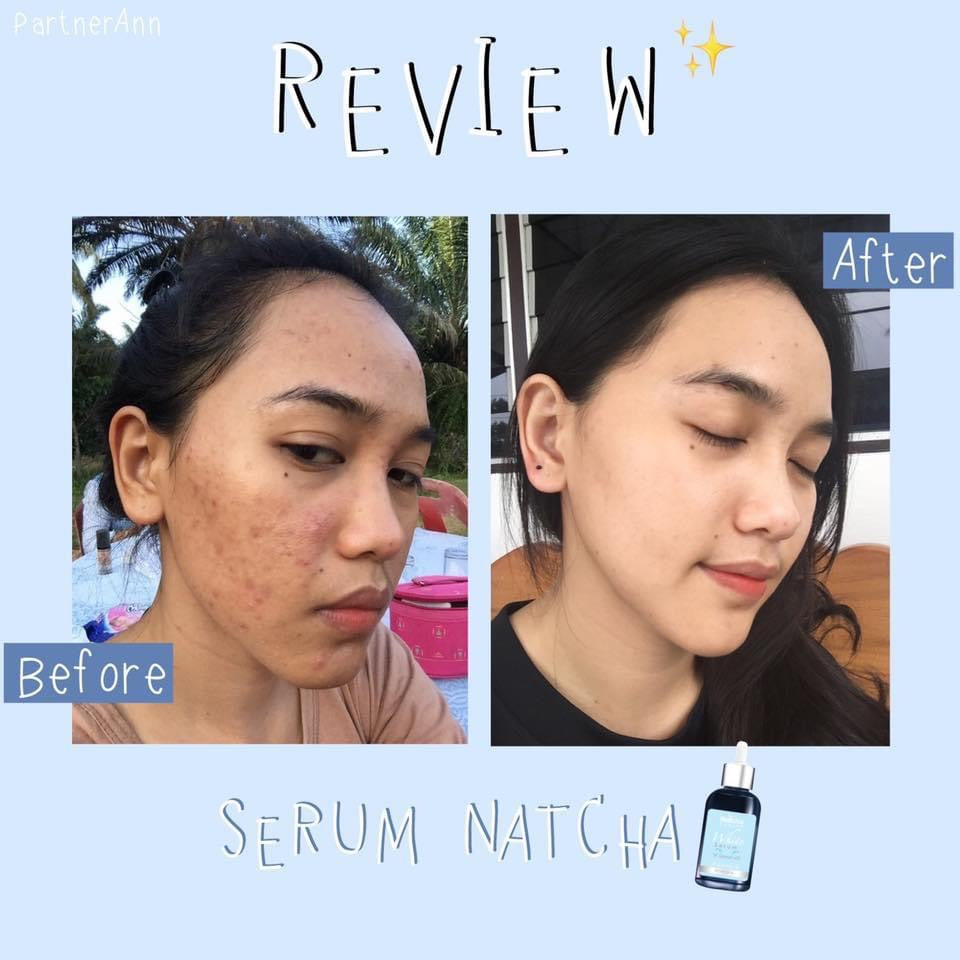 Natcha serums ทลายฝ้า 30 ml